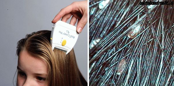 Избавление от педикулеза