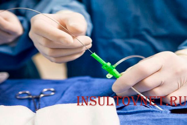 Тромболитическая терапия