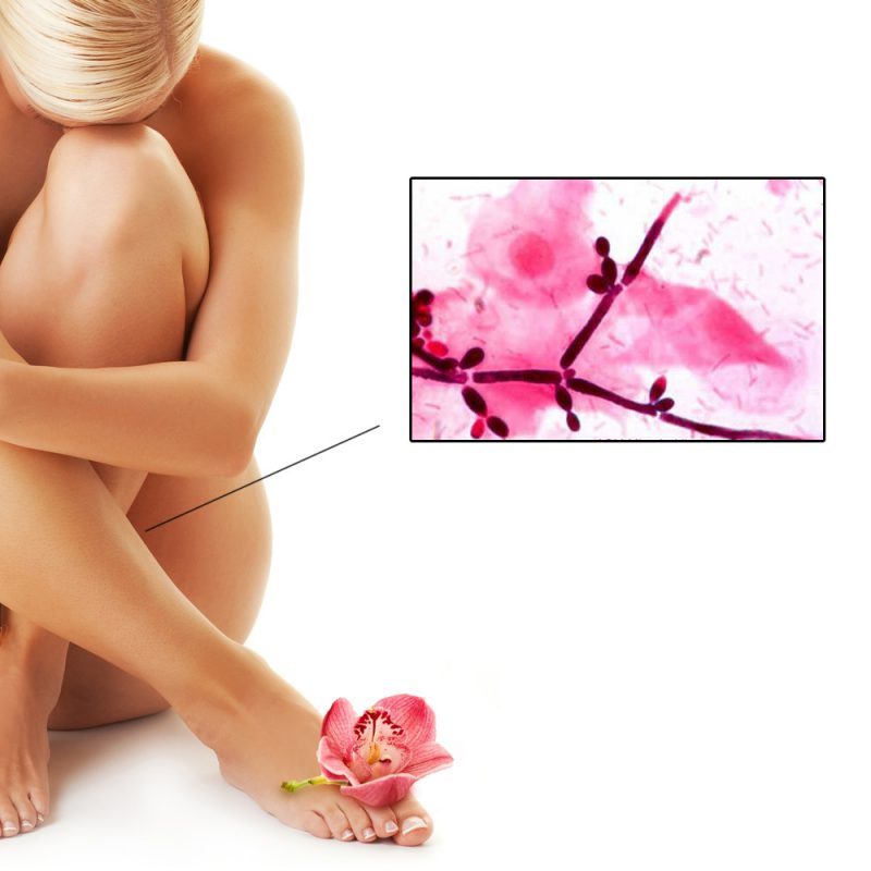 Candida у женщины