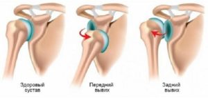 Передний и задний вывихи плечевого сустава Виды вывихов плеча