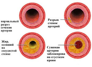 Почему возникает гипертония у человека