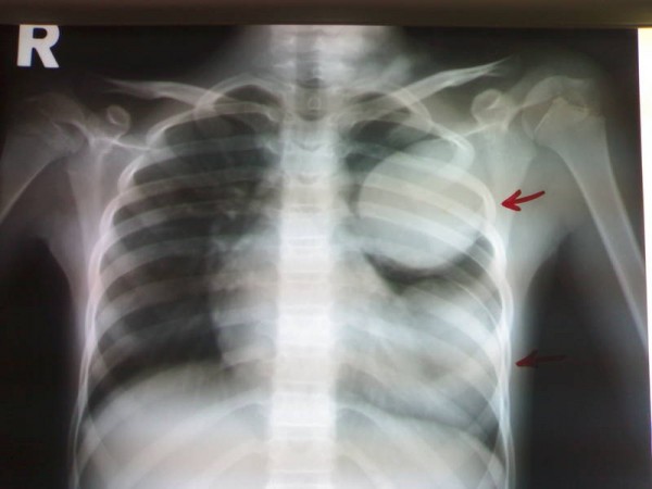 гельминты в легких