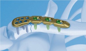 Фиксатор ключицы При остеосинтезе используют пластмассовые и металлические фиксаторы