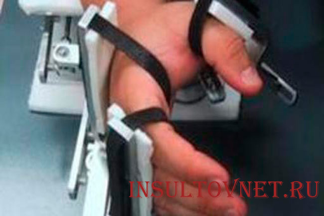 Парализация рук