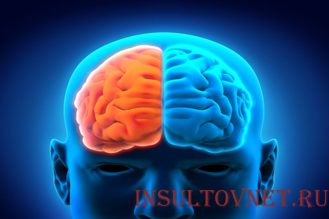 Инсульт правой стороны