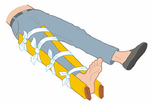 Нога привязанная к палкам Транспортную иммобилизацию можно выполнять из подручных средств