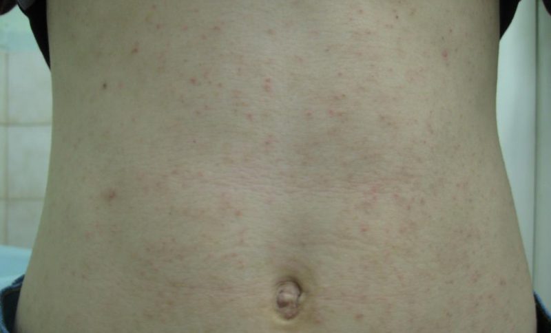 сыпь по телу