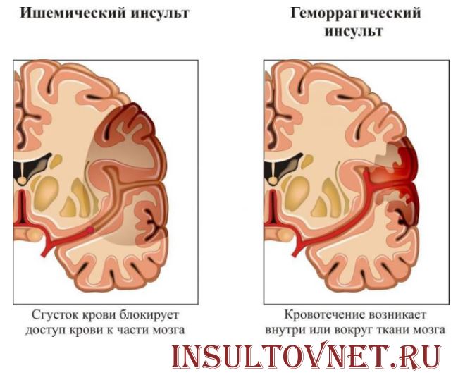 Виды инсульта