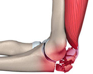 Оскольчатый перелом сустава Перелом локтевого сустав