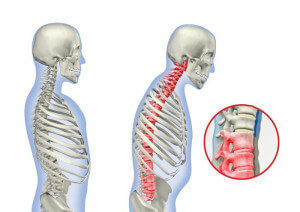 Симптомы остеохондроза грудного