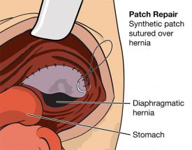 Методы диагностики и лечения диафрагмальной грыжи у новорожденных