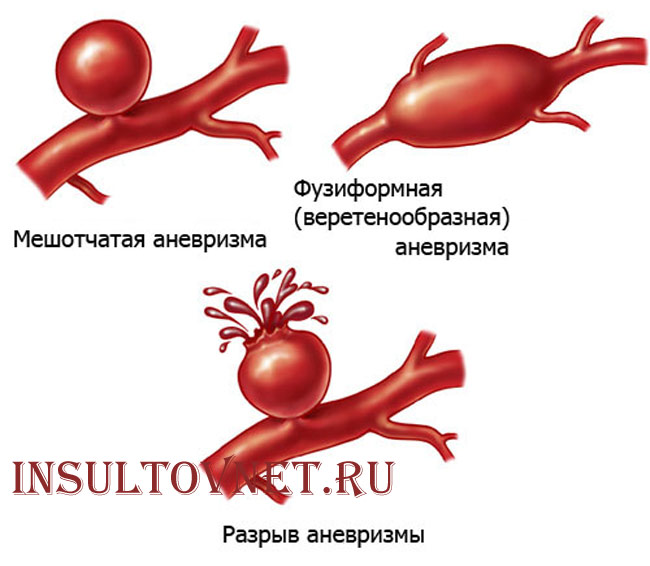 разрыв аневризма головного мозга