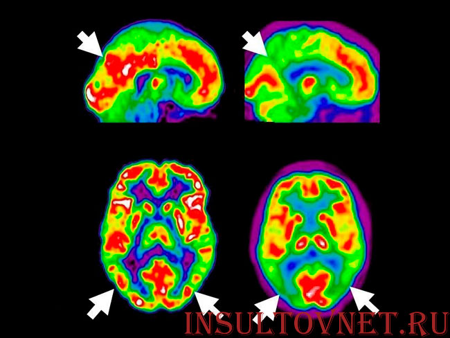 ПЭТ при Альцгеймере
