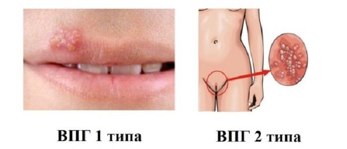 вирусс герпеса 1 и 2 типа