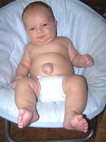 Лечение пупочной грыжи у детей без вмешательства хирурга