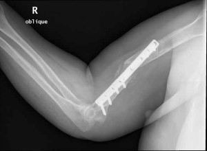 Титановая пластина в руке При травмах руки используются специальные фиксаторы, пластины или анкеры