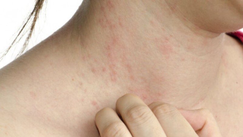 признаки чесотки