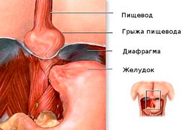 Особенности и противопоказания операции при грыже пищевода
