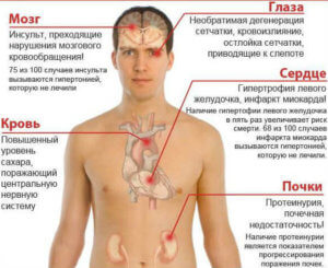 Чем опасна гипертония для человека