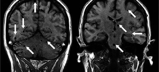 Виды мозговых паразитов, симптомы, диагностика и лечение
