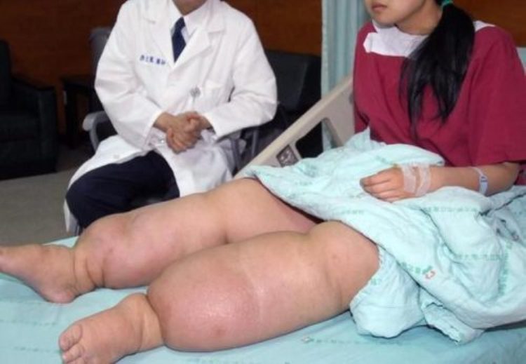 стадии филяриоза