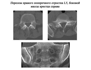 Рентген при правостороннем переломе Правосторонний перелом поперечного отростка