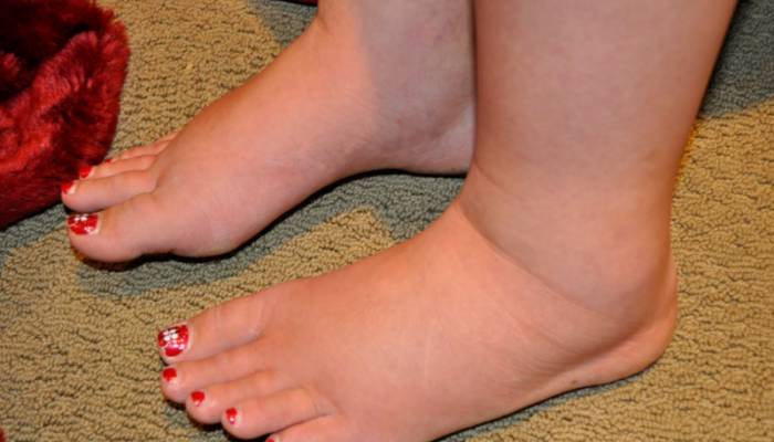 Элефантиаз