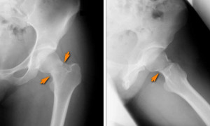 Рентген Рентген при стрессовом переломе