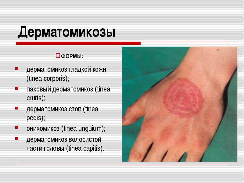Дерматомикозы