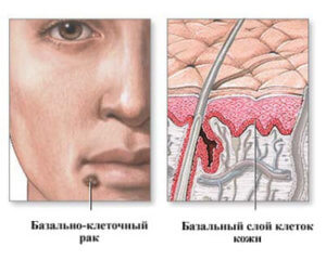 Как выглядит рак базально-клеточный