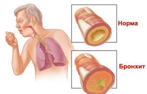 Как выглядит стенка бронхов у человека
