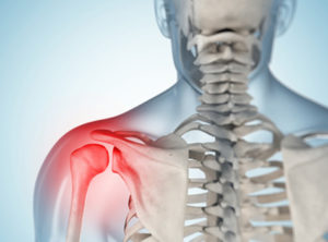 Привычный вывих плеча Головка кости вышла из суставной сумки