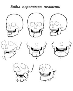Виды повреждений нижней челюсти Возможные переломы нижней челюсти