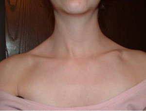 Симптом перелома Первым симптомом перелома является умеренный отек в области повреждения