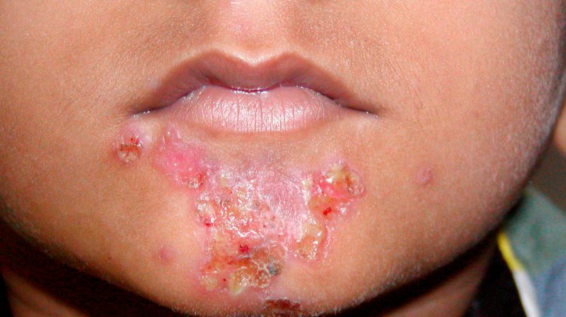 раны на подбородке