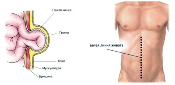 Грыжа белой линии живота - без лечения неизбежны осложнения