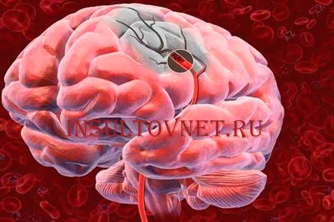 Последствия после инсульта