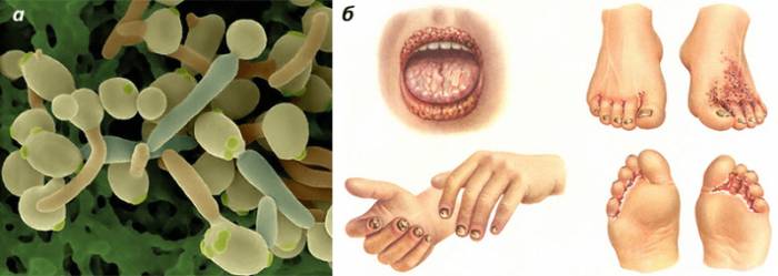 грибки у человека