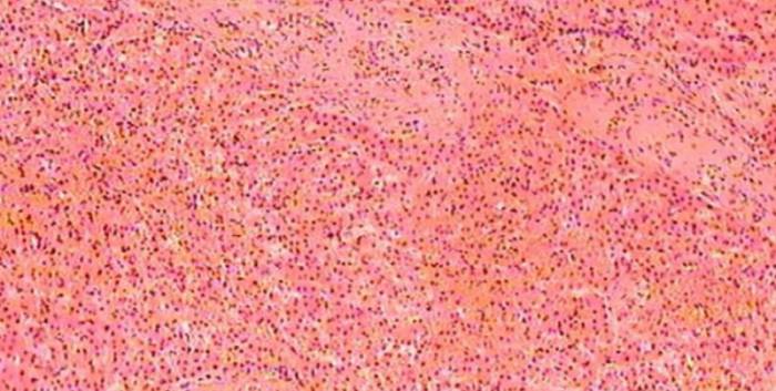 фиброз печени