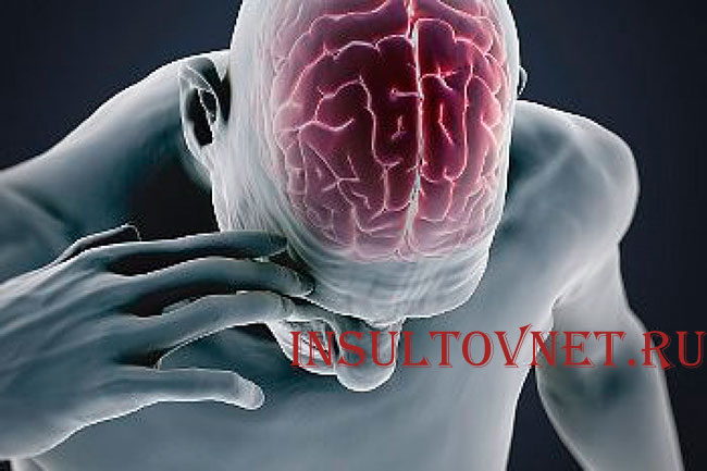 Последствия после инсульта