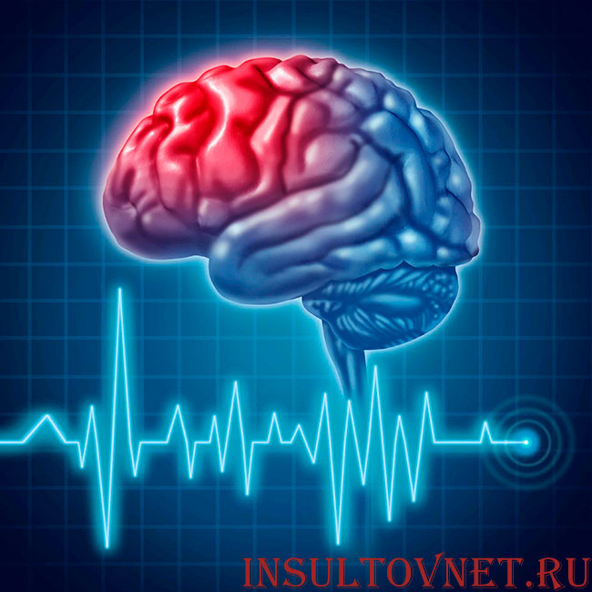 зона инсульта