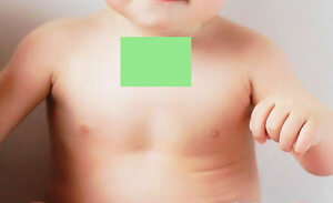 Горчичник при кашле и простуде ребенка