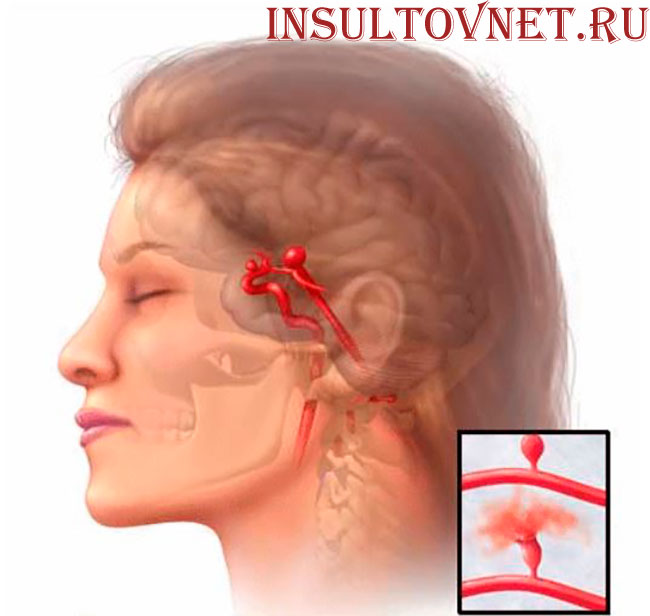 аневризма сосудов мозга
