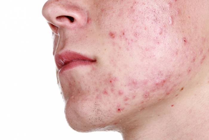 Демодекоз у человека