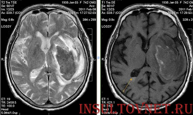 томография инсульта
