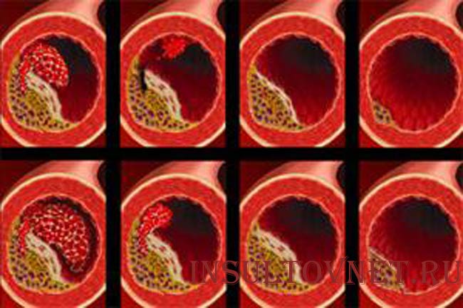 Атеросклеротическая бляшка в аорте