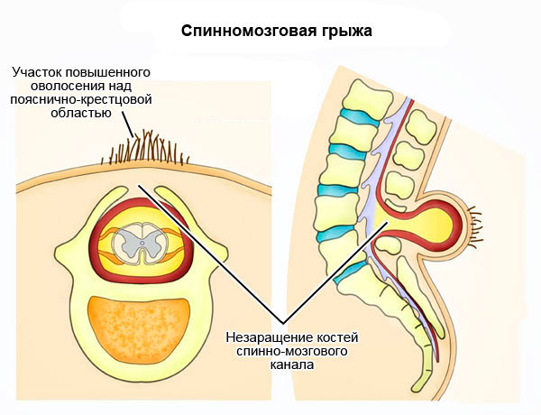 Эффективные методы диагностики и лечения спинномозговой грыжи