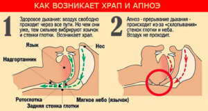 Как возникает храп и апноэ