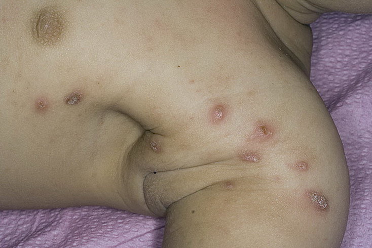 как проявляется чесотка