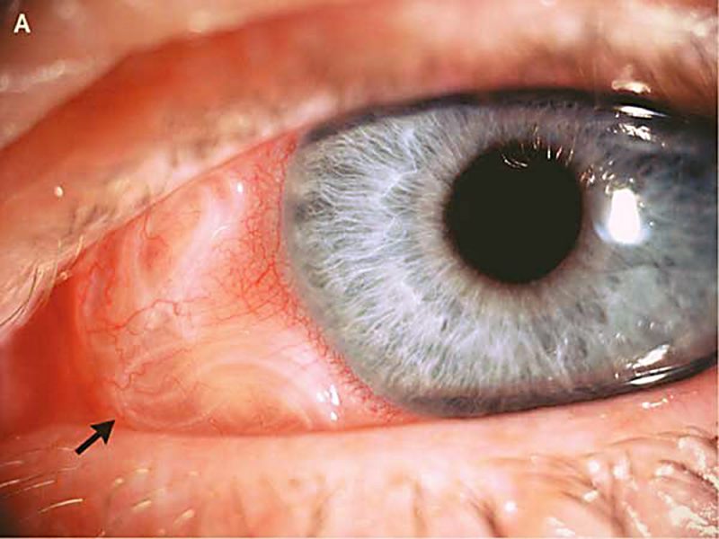 Глисты в глазу у человека